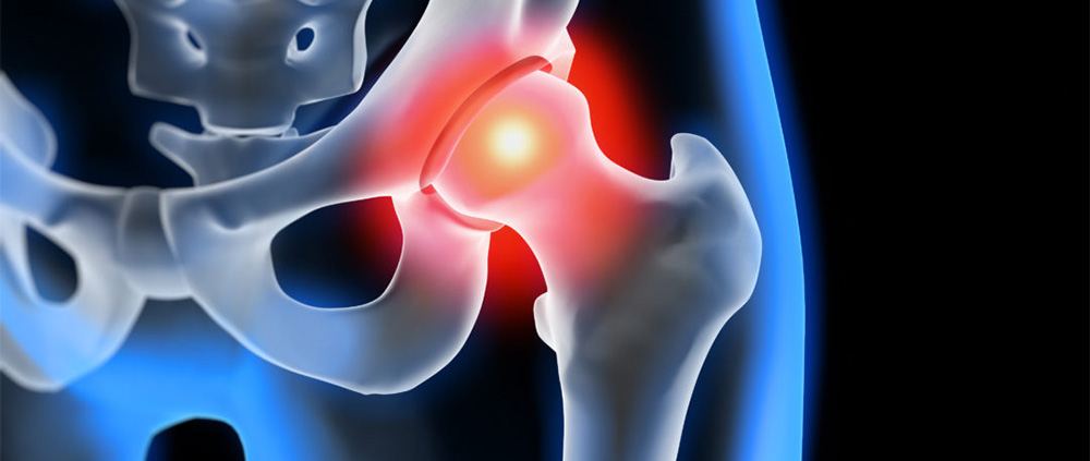 La coxartrosi o semplicemente artrosi dell’anca